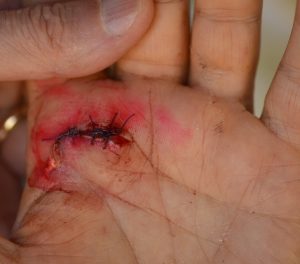 Child Injury: Learn How To Take Quality Pictures For Your Case - Mukerji Law