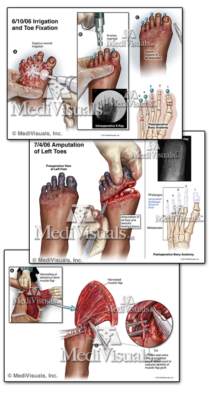 Girl Who Lost Her Toe Go-Carting Wins $1.5 Million Verdict - Mukerji Law