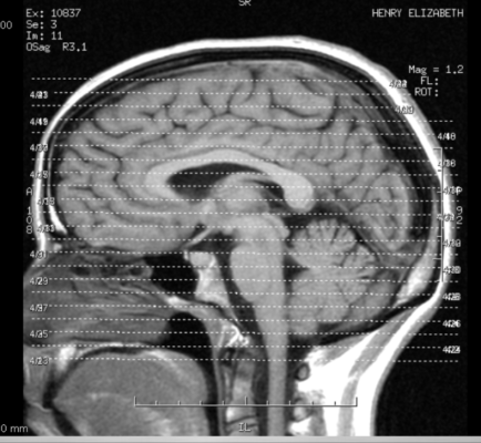 Head Injuries: What Actually Happens To Your Brain - Mukerji Law