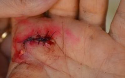 Child Injury: Learn How To Take Quality Pictures For Your Case - Mukerji Law