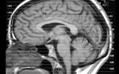 Head Injuries: What Actually Happens To Your Brain - Mukerji Law