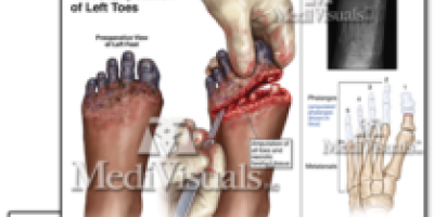 Girl Who Lost Her Toe Go-Carting Wins $1.5 Million Verdict - Mukerji Law